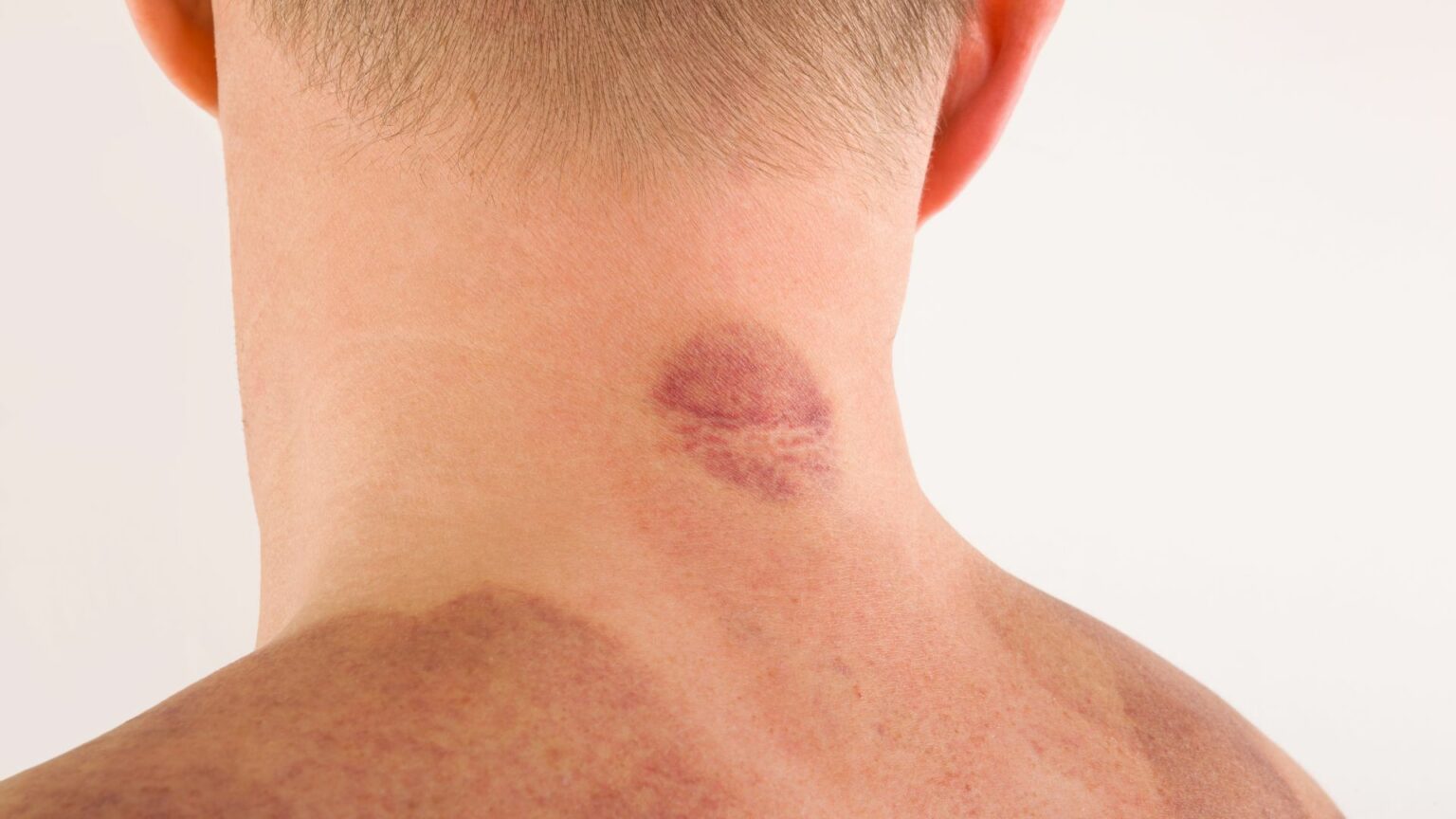 How To Remove A Hickey With Toothpaste? 4 More Natural Ways Power Tooth Paste