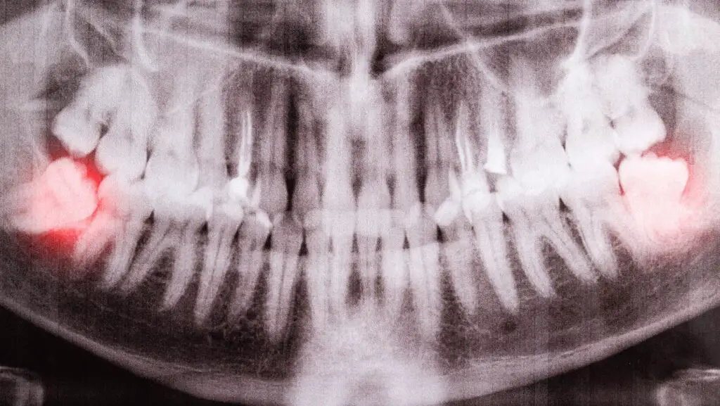 Wisdom Teeth Removal Affect Intelligence