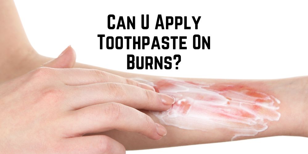 can you apply toothpaste on burns